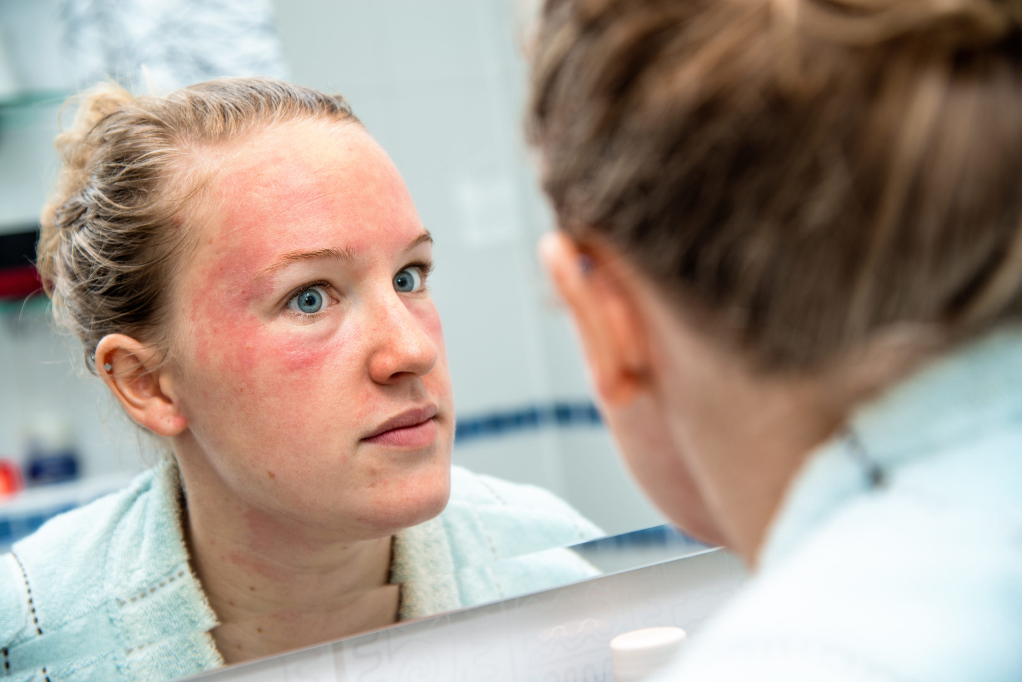 Eczema on face treatment. Women with facial eczema looking in mirror. Eczema Cream, Natural Eczema Cream Australia Hope's Relief