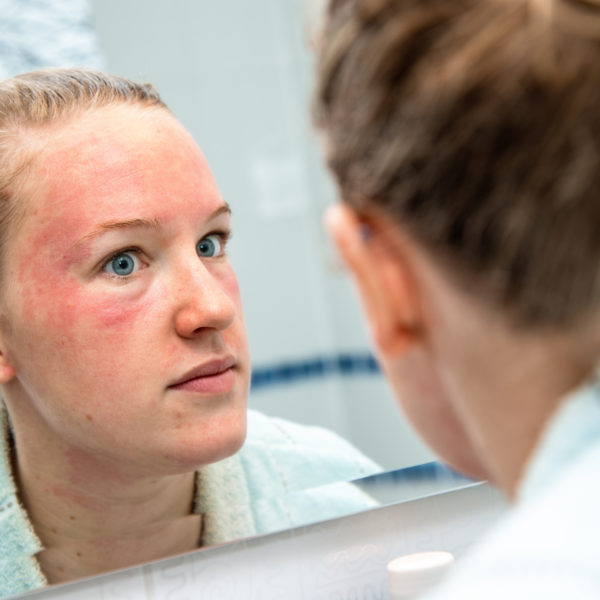 Eczema on face treatment. Women with facial eczema looking in mirror. Eczema Cream, Natural Eczema Cream Australia Hope's Relief