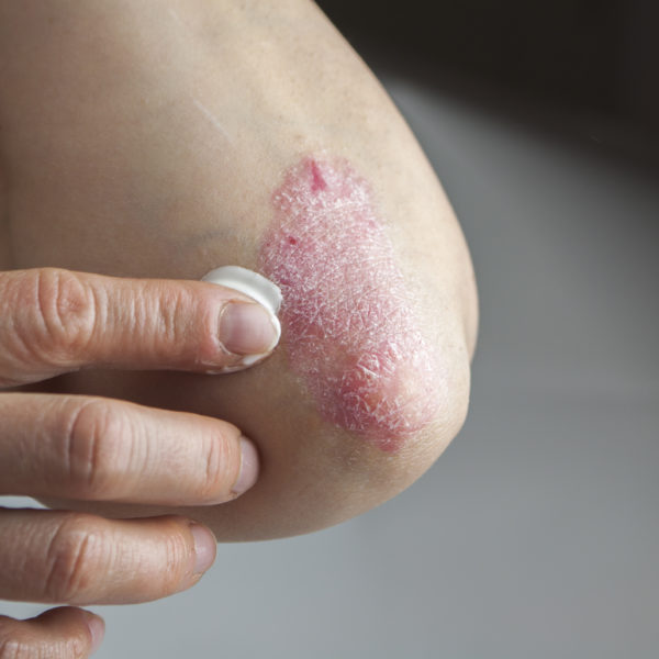 First Signs of Psoriasis